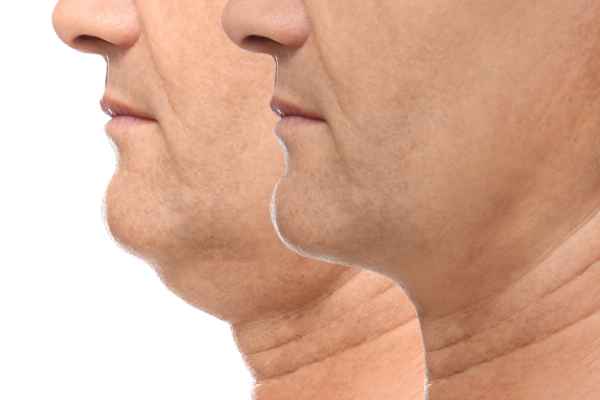 HIFU - Breakthrough in Anti - ageing 2 hifu results Crewe