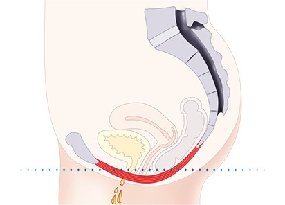 Pelvic-Floor Muscle Repair 5 Pelvic floor muscles Crewe