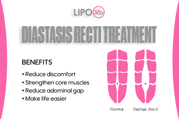 Revolutionising Muscle Repair: The Power of LIPO360 Body Sculpt Post-Injury 5 diastasis recti treatment Crewe