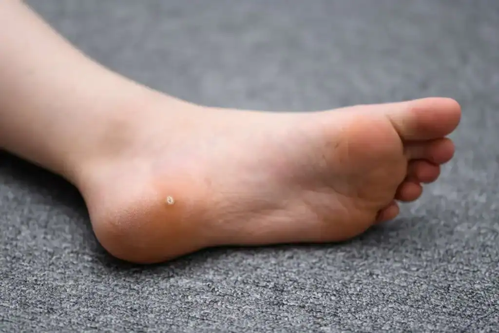 Cryotherapy For Warts And Also Verrucas 2 Image of verruca on the bottom of the foot that able to be treated with Cryotherapy Crewe