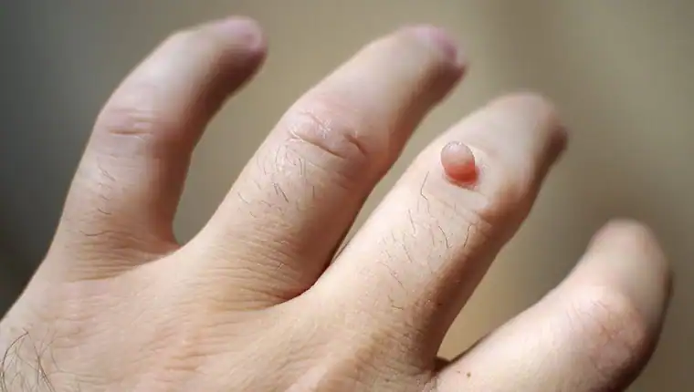 Image of blemish that Cryotherapy Crewe can remove with Lipo 360.