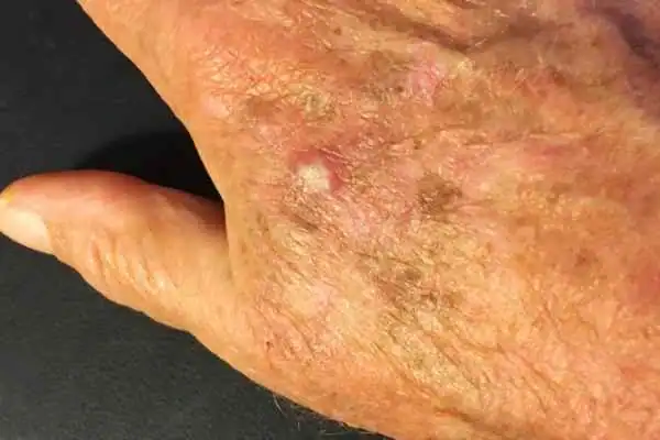 Image of Actinic keratoses Crewe on a person hand