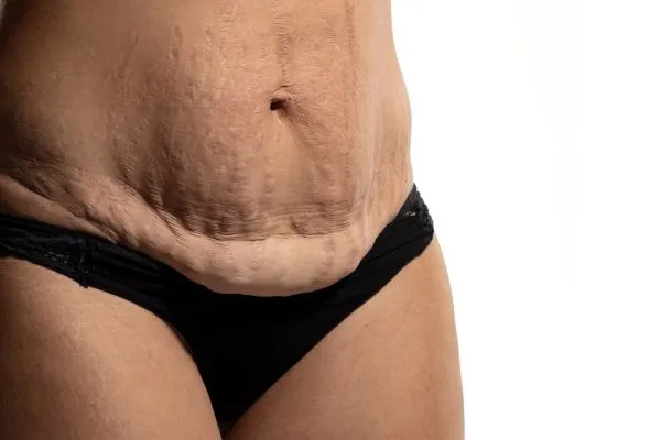 The science behind skin tightening Crewe picture of a woman's sagging skin on the stomach